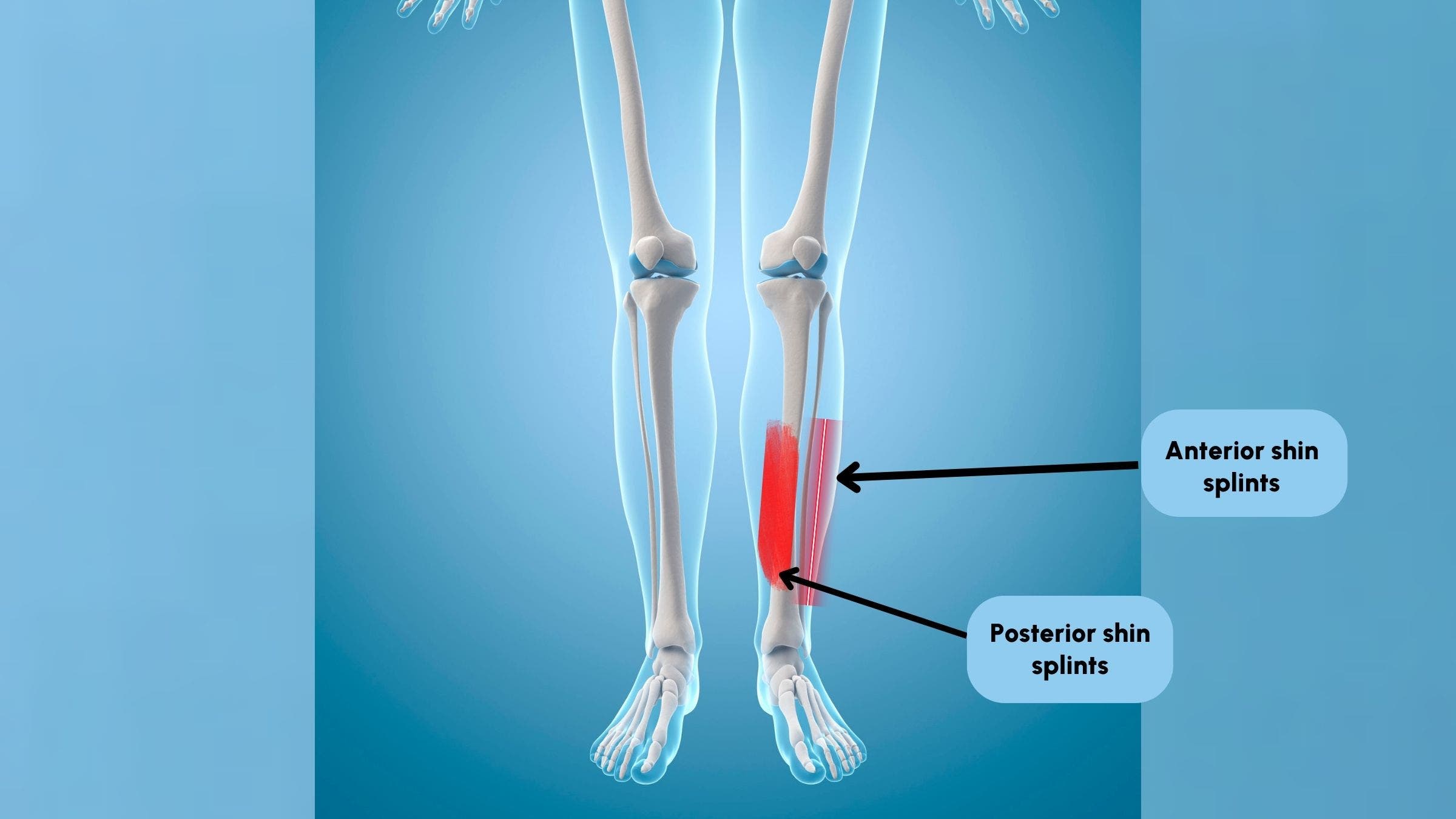 ipamorelin shin splints Treatment Irvine, Huntington Beach Shin Splints Treatment - What