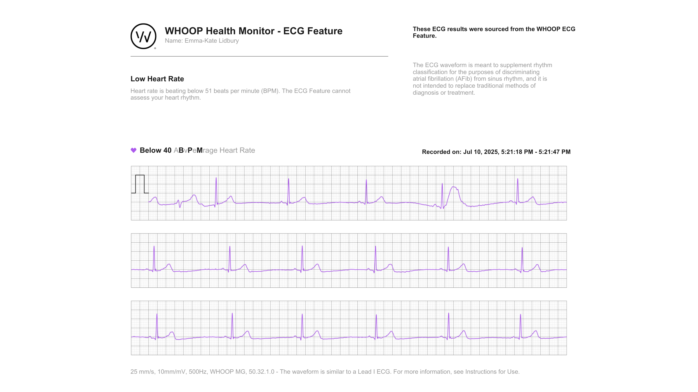 Whoop MG ECG reading
